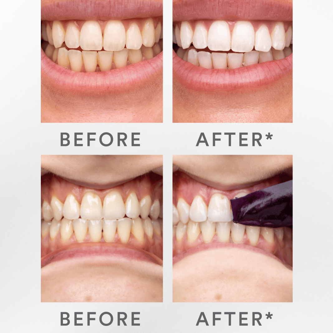 Gleammore Whitening Strips
